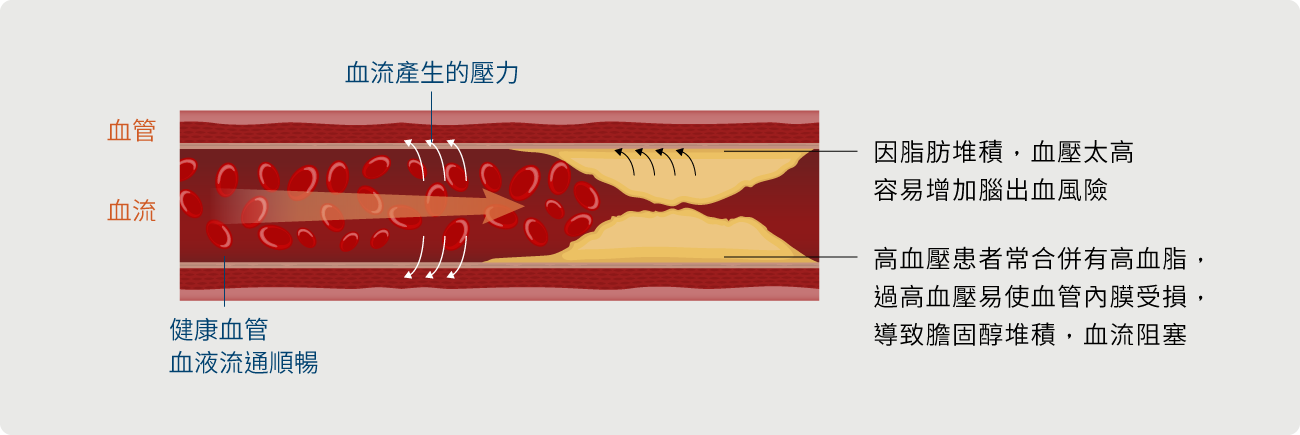 EECP 治療的適合族群 