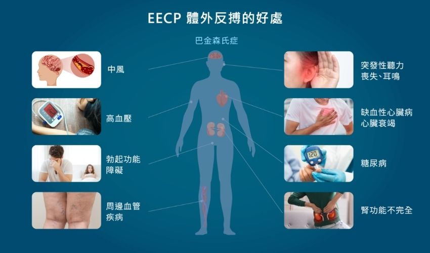 EECP體外反搏治療運作原理示意圖